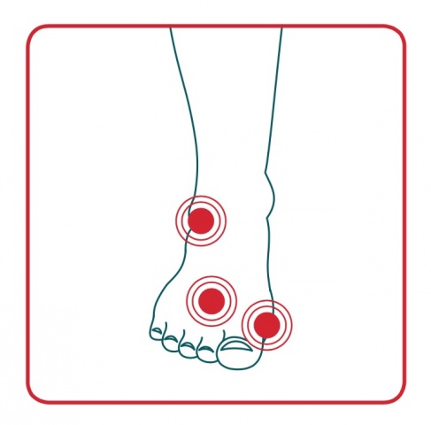 areas of the foot affected by bunions