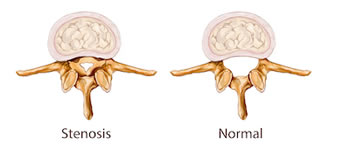Spinal Stenosis creates serious pain for farmers