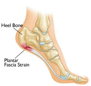 Plantar Fasciitis creates serious pain for runners