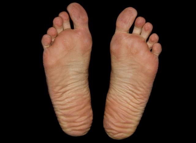 common-foot-problems-runners