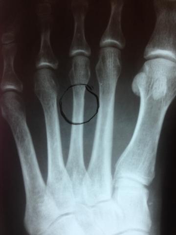 Fractures are a common injury that occurs from horseback riding
