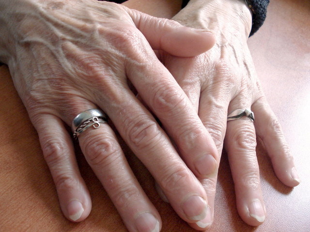 Arthritis-hand-pain