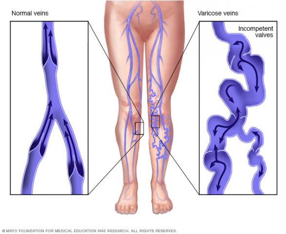 witch-hazel-varicose-vein-pain