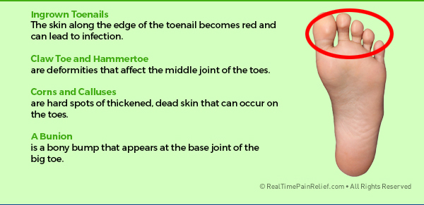 Conditions that affect the toes